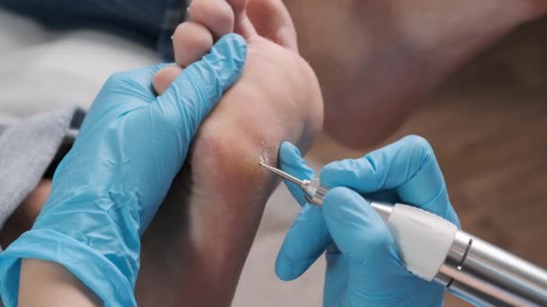 用电钻把妇女脚上的愈伤组织取出来 — 图库视频影像