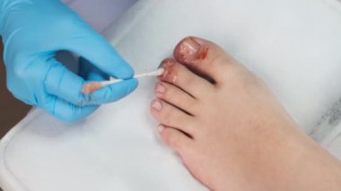 Podoloji uzmanı tırnağı mantar önleyici bir maddeyle tedavi ediyor.. 