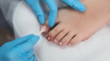 Podoloji uzmanı tırnağı mantar önleyici bir maddeyle tedavi ediyor.. 