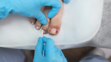 Podolojist ayak tırnaklarını mantar önleyici bir maddeyle tedavi ediyor..