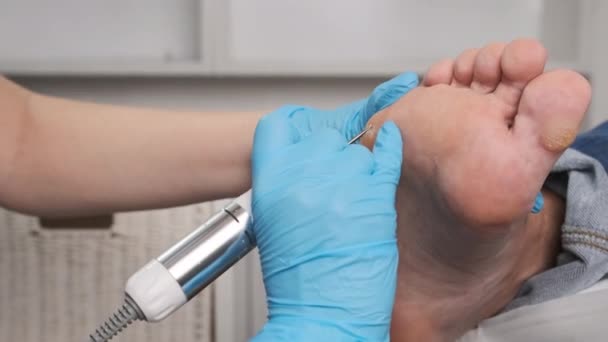 Крупним Планом Видалення Мозолів Допомогою Електричного Дриля Жіночій Нозі Медичному — стокове відео