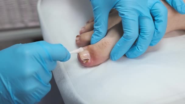 表彰者は爪を検査し 抗真菌治療を適用する — ストック動画