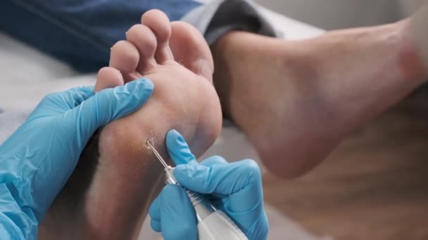 Podologist Removes Callus Patients Toe — Stock Video