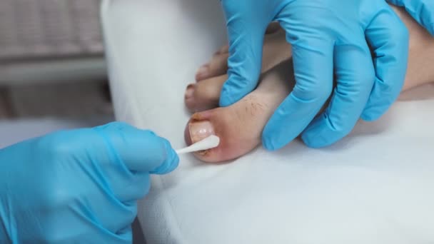 一位足科医生用抗真菌剂治疗脚趾甲 — 图库视频影像