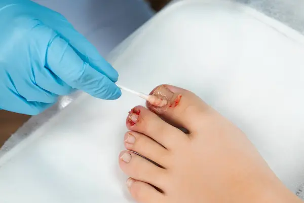 stock image Close up podologist treats the nail with an antifungal agent. 