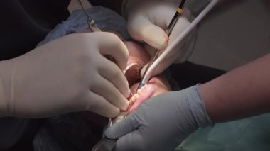 Diş hekimi kadın hastalara oral cerrahi işlem uygular. Profesyonel, dişlere temiz erişim için kadın çenesini açık tutmak için ağız desteği kullanır