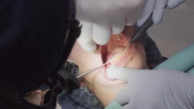 Dişçi, kadın hastayla oral cerrahi işlem sırasında dikiş atıyor. Alanı tam olarak işlemek için kullanılan ince uçlu araç ve forseps
