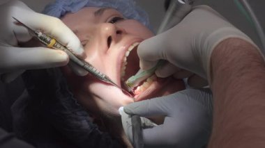 Bir grup dişçi, dişlerin kalan kısımlarını kadın hasta boşluğunda matkapla çıkarır. Uzmanlar implant yerleştirme hazırlıklarına odaklandılar