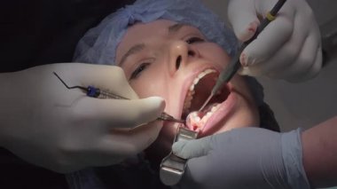 Diş hekimi kadın yirmilik diş çıkarma ameliyatını gerçekleştiriyor. Doktorlar çeneyi açık tutmak için ağız desteği kullanır ve dişlere temiz erişim sağlar
