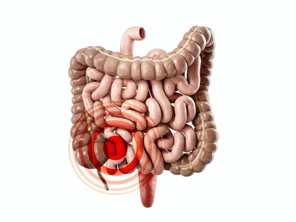 Illustration Human Internal Organ Intestine Sick Intestine Concept — Stockfoto