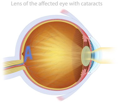 Illustration about ocular cataract is the progressive opacification of the lens, causing blurred vision, sensitivity to light, and decreased visual acuity. Its main treatment is lens removal surgery. clipart