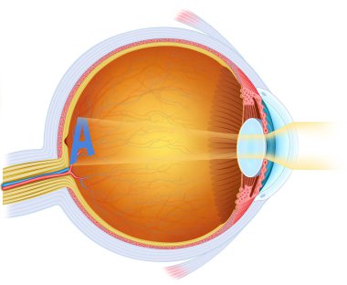 Illustration of the normal visual focus of the eye. This allows you to see clearly, forming the image directly on the retina, thanks to the correct curvature of the cornea and the lens. clipart