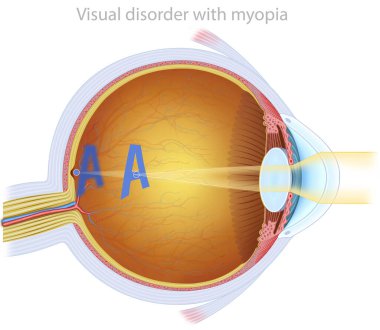 Görüntü retinadan önce oluştuğu için, miyopla görsel odaklanma, uzak nesneleri net bir şekilde görmeyi zorlaştırır..