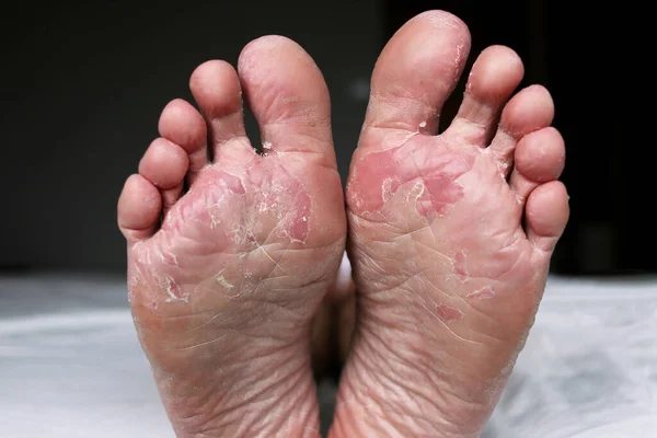 Close up of dry feet. Peeling and cracked foot. Fungal infection or athletes foot, dry skin, dermatitis, eczema, psoriasis, sweaty feet or dehydration. Health care concept