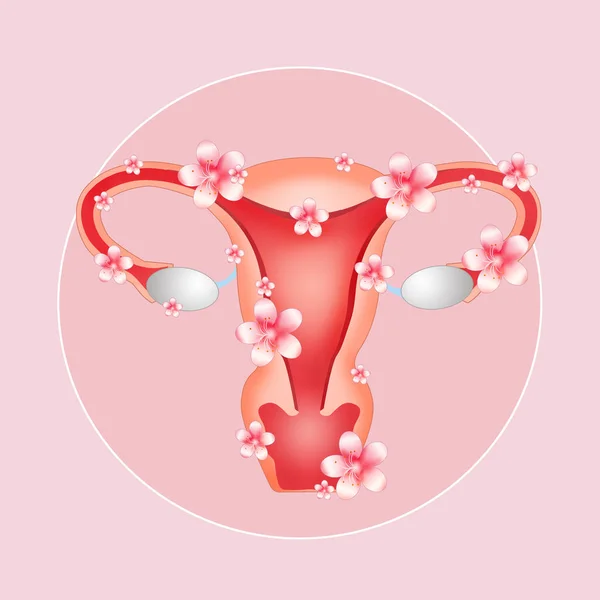 Illustration Uterus Endometriosis — Stock Photo, Image