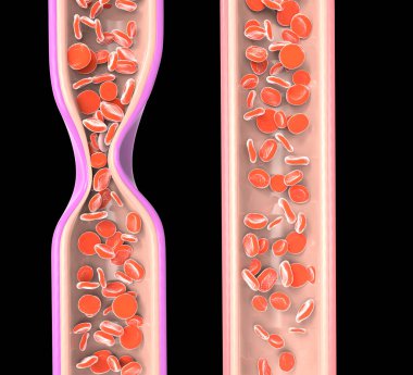 Obstructed vein due to thrombosis and normal vein with blood cells. 3D rendering clipart