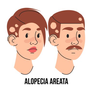 Alopecia areata vektörü izole edildi. Erkek ve kadın karakter saç dökülmesinden muzdarip. Sağlık sorunları var. Tıbbi durum.
