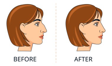 Vektör Resimlerinden Önce ve Sonra Kadın Rhinoplasti. Estetik cerrahi bilgileri. Cerrahi öncesi ve sonrası kadın profili karşılaştırması, tıbbi sunumlar, kozmetik kliniği