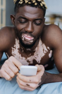 Şüpheci Afro-Amerikalı Vitiligo 'lu adam yatakta bulanık akıllı telefon kullanıyor. 