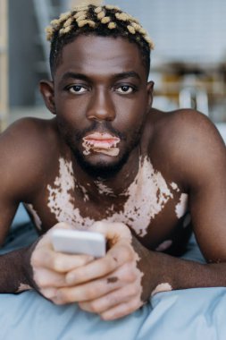 Vitiligo 'su olan Afro-Amerikan bir adamın portresi. Elinde akıllı telefon, evinde yatarken kameraya bakıyor. 