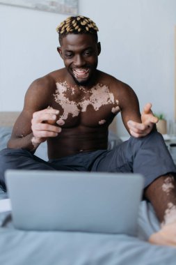 Vitiligo 'su olan neşeli Afro-Amerikalı adam laptopuyla yatak odasında video görüşmesi yapıyor. 