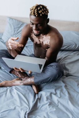 Gülümseyen ve gömleksiz Vitiligo 'su olan Afro-Amerikalı adam laptopuyla yatağında video görüşmesi yapıyor. 