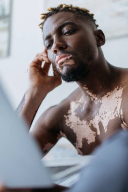 Vitiligo 'su olan odaklanmış Afro-Amerikan adam evde bulanık laptop kullanıyor. 