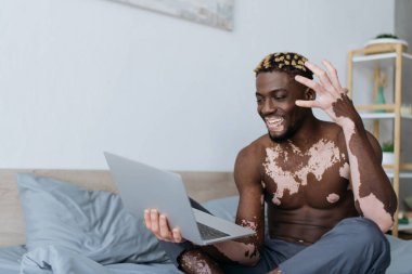 Kaygısız Afro-Amerikalı Vitiligo 'lu adam yatak odasında dizüstü bilgisayarında görüntülü sohbet yapıyor. 