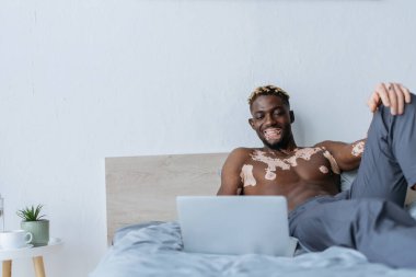 Vitiligo 'lu gülümseyen Afro-Amerikan adam evde yatağında dizüstü bilgisayara bakıyor. 
