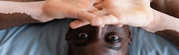Horní Pohled Mladého Afrického Američana Vitiligem Zakrývající Tvář Posteli Prapor — Stock fotografie