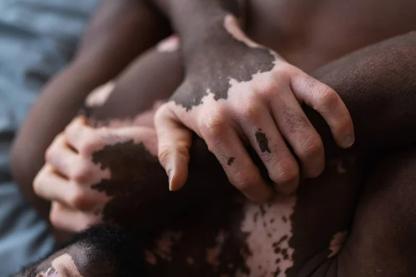 ベッドの上に横になっている間に手に触れるVitiligoアフリカ系アメリカ人の男の作物ビュー ホーム — ストック写真