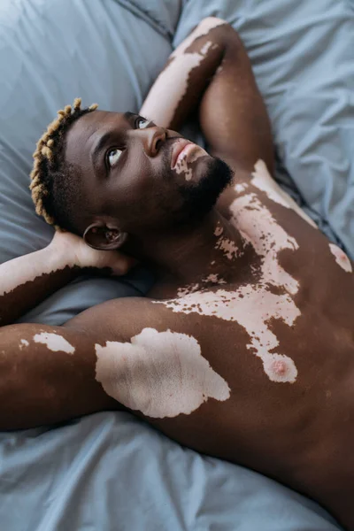 Vista Ángulo Alto Del Hombre Afroamericano Sin Camisa Con Vitiligo —  Fotos de Stock