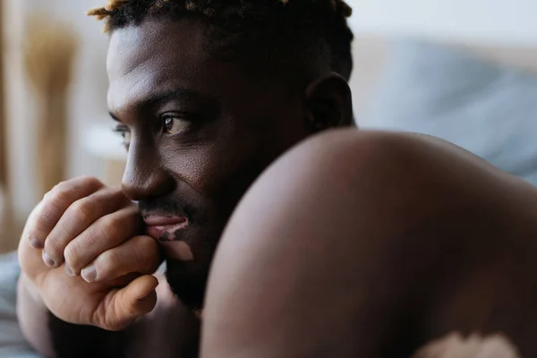 Портрет Безсоромного Африканського Американця Вітиліго Який Дивиться Спальні — стокове фото