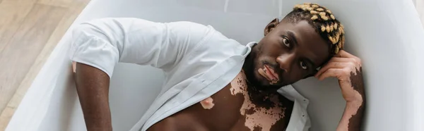Vue Dessus Homme Afro Américain Avec Vitiligo Chemise Couchée Dans — Photo
