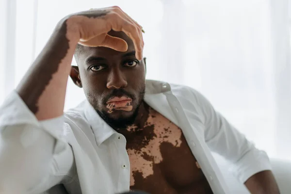 Afrikanischer Mann Mit Vitiligo Hemd Schaut Hause Die Kamera — Stockfoto