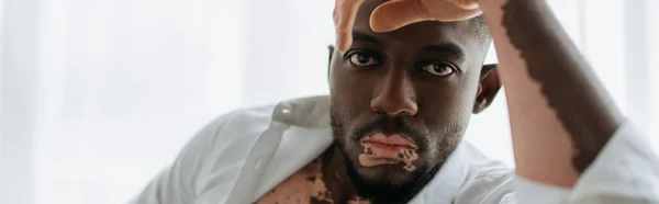 Vitiligo Tişörtlü Genç Afrikalı Amerikalı Adam Evdeki Kameraya Bakıyor Afiş — Stok fotoğraf