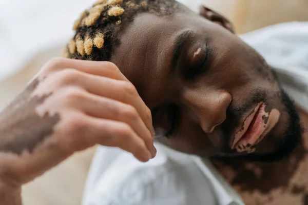 Porträt Eines Afrikanisch Amerikanischen Mannes Mit Vitiligo Der Hause Verschwommener — Stockfoto
