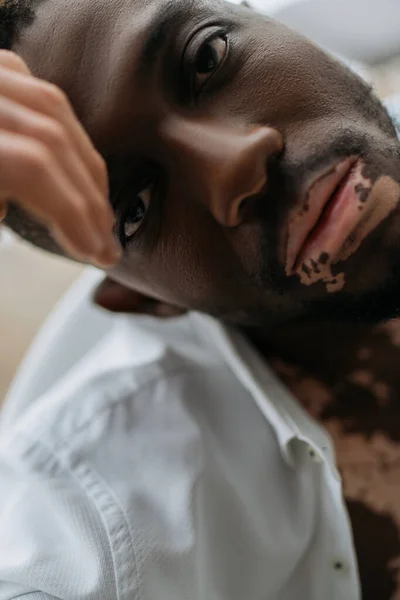 Retrato Hombre Afroamericano Con Vitiligo Camisa Blanca Sentado Bañera Borrosa — Foto de Stock