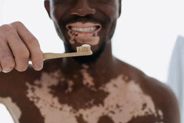 アフリカ系アメリカ人の男の笑顔の作物ビューとともにVitiligo保持歯ブラシで歯磨き粉 — ストック写真