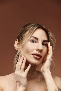 Vitiligo 'su olan genç bir kadın bej bir arka plana karşı poz veriyor, eşsiz güzelliğini ve özgüvenini sergiliyor..