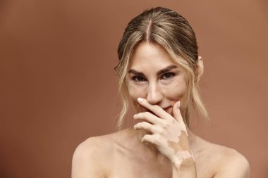 Vitiligo 'lu genç bir kadın portre için poz veriyor, eliyle ağzını kapatıyor ve kameraya hafifçe gülümsüyor..