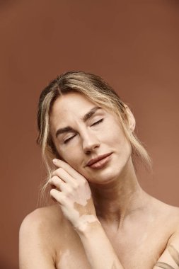 Vitiligo 'su olan genç bir kadın, bej arka planda çıplak omuzlarıyla poz veriyor..