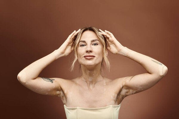 A young woman with vitiligo poses with her arms raised, revealing a tattoo on her arm against a beige backdrop.