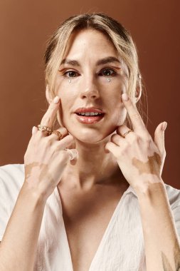 Vitiligo 'su olan genç bir kadın bej bir arka plana karşı beyaz bir yaz elbisesi içinde poz veriyor ve eşsiz güzelliğini sergiliyor..