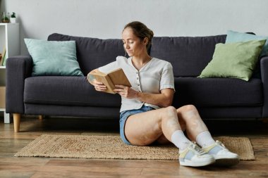 Vitiligo 'su olan genç bir kadın yerde oturuyor, kendini kitabına kaptırmış, etrafı rahatlıkla çevrili..
