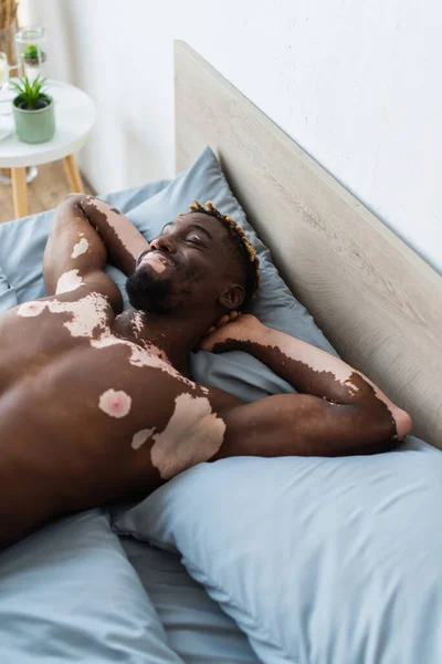 Lächelnder afrikanisch-amerikanischer Mann mit Vitiligo entspannt sich zu Hause im Bett — Stockfoto
