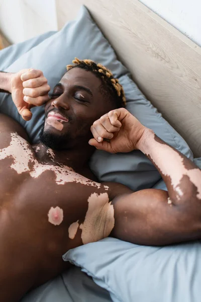Радісний афроамериканець з вітиліго лягає на ліжко вранці. — стокове фото