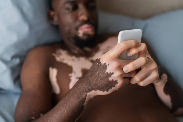 Blurred african american man with vitiligo using smartphone on bed — Stock Photo