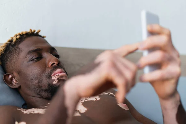 Sans chemise homme afro-américain avec vitiligo en utilisant un téléphone portable sur le lit — Photo de stock