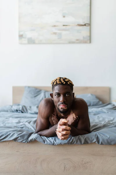 Африканский мужчина без рубашки с витилиго смотрит в камеру, лежа дома на кровати — стоковое фото